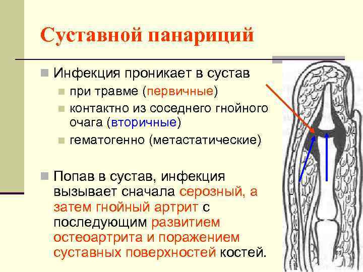 Суставной панариций n Инфекция проникает в сустав n при травме (первичные) n контактно из