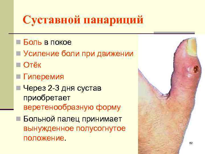 Суставной панариций n Боль в покое n Усиление боли при движении n Отёк n