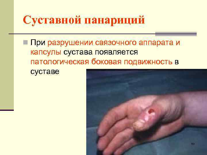 Суставной панариций n При разрушении связочного аппарата и капсулы сустава появляется патологическая боковая подвижность