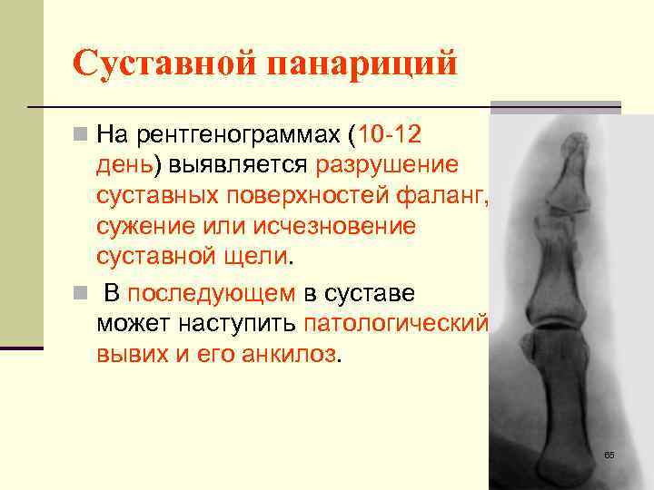 Суставной панариций n На рентгенограммах (10 -12 день) выявляется разрушение суставных поверхностей фаланг, сужение