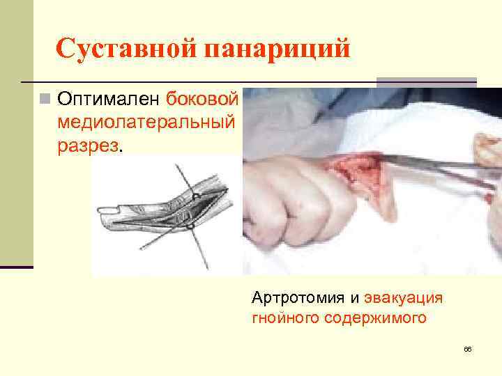 Суставной панариций n Оптимален боковой медиолатеральный разрез. Артротомия и эвакуация гнойного содержимого 66 