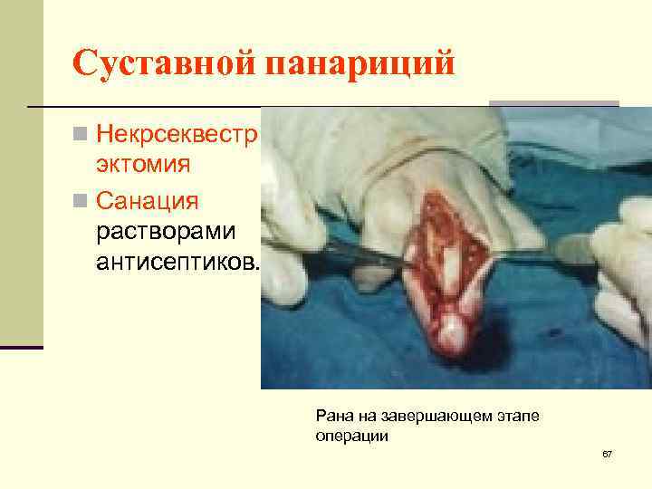 Суставной панариций n Некрсеквестр эктомия n Санация растворами антисептиков. Рана на завершающем этапе операции