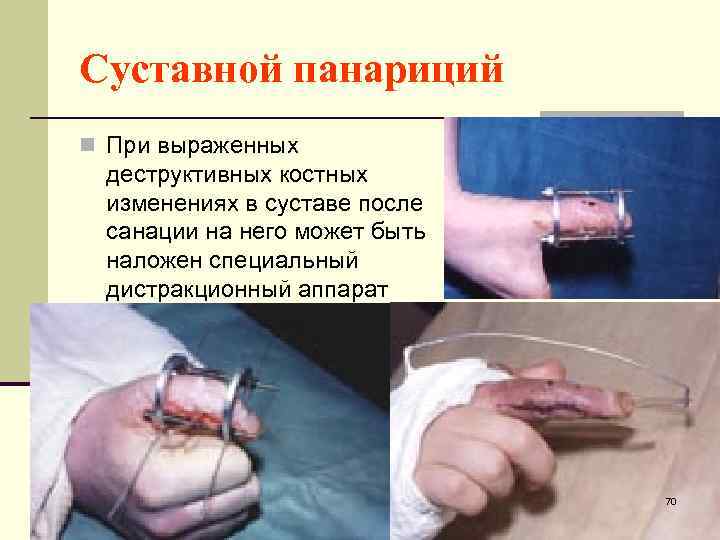 Суставной панариций n При выраженных деструктивных костных изменениях в суставе после санации на него