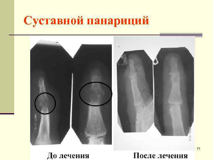Суставной панариций 71 