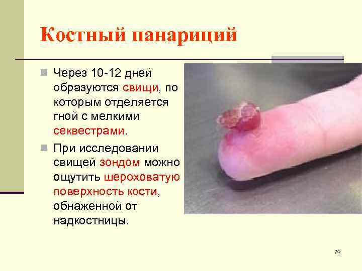 Костный панариций n Через 10 -12 дней образуются свищи, по которым отделяется гной с