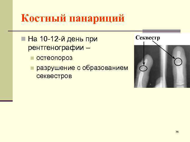Костный панариций n На 10 -12 -й день при рентгенографии – остеопороз n разрушение