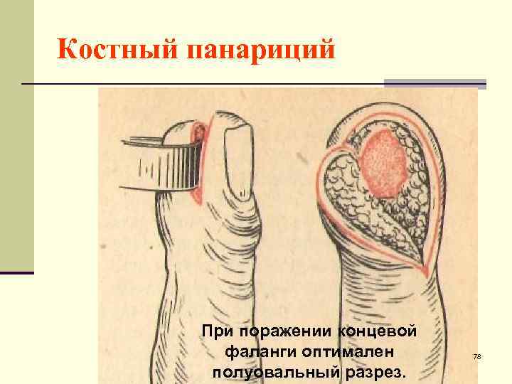 Костный панариций При поражении концевой фаланги оптимален полуовальный разрез. 78 