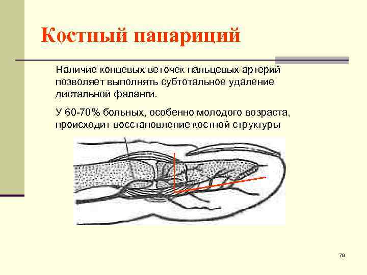 Костный панариций Наличие концевых веточек пальцевых артерий позволяет выполнять субтотальное удаление дистальной фаланги. У