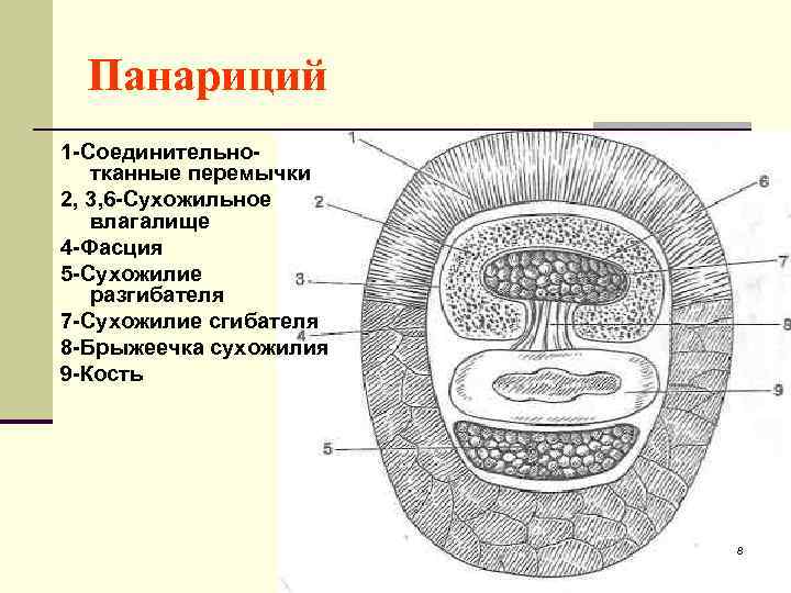 Панариций 1 -Соединительнотканные перемычки 2, 3, 6 -Сухожильное влагалище 4 -Фасция 5 -Сухожилие разгибателя