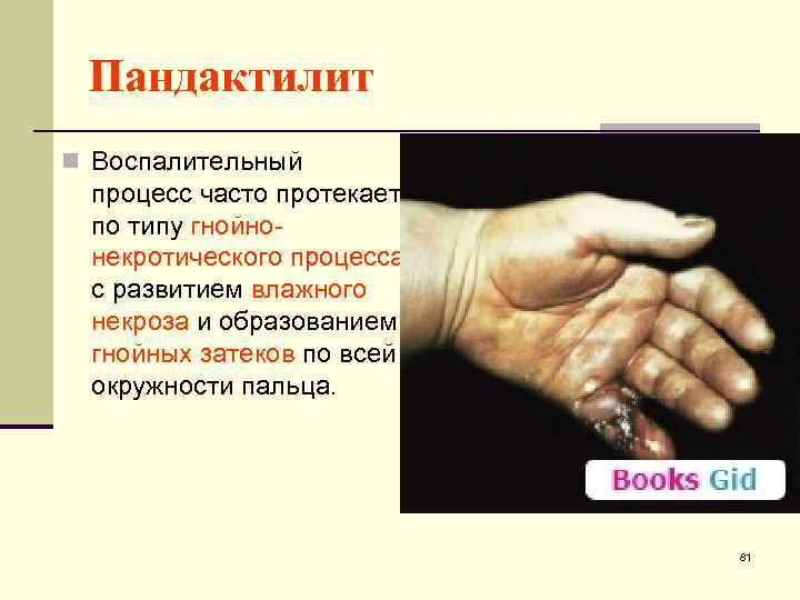 Пандактилит n Воспалительный процесс часто протекает по типу гнойнонекротического процесса с развитием влажного некроза