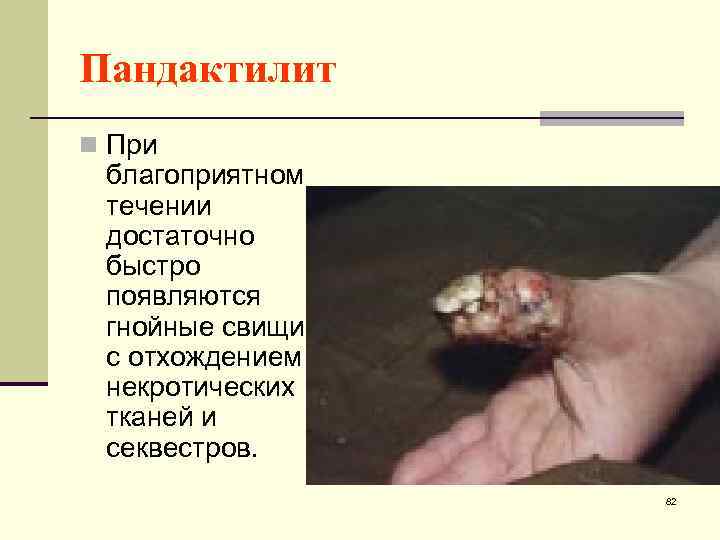 Пандактилит n При благоприятном течении достаточно быстро появляются гнойные свищи с отхождением некротических тканей