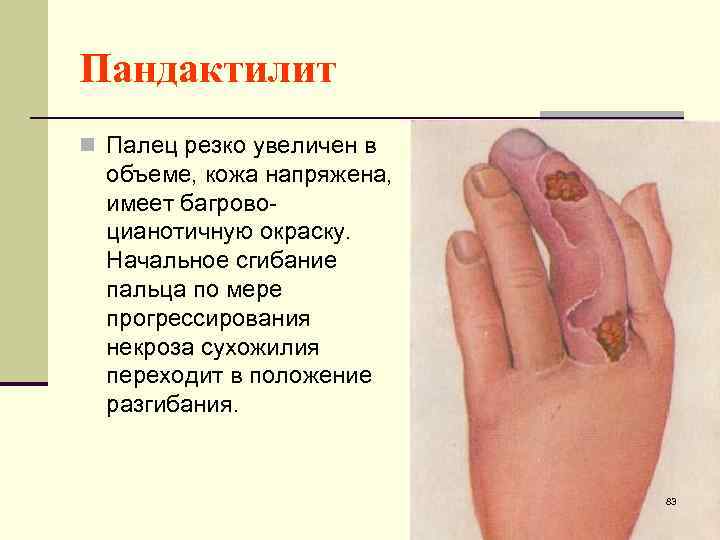 Пандактилит n Палец резко увеличен в объеме, кожа напряжена, имеет багровоцианотичную окраску. Начальное сгибание