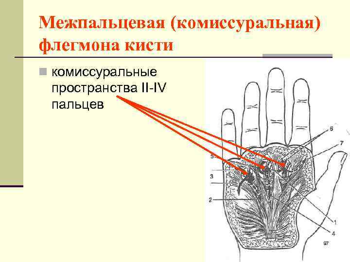 Межпальцевая (комиссуральная) флегмона кисти n комиссуральные пространства II-IV пальцев 97 