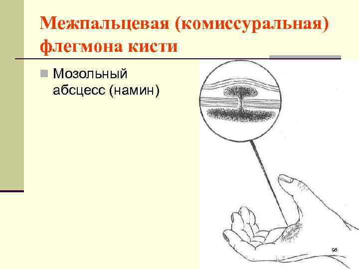 Межпальцевая (комиссуральная) флегмона кисти n Мозольный абсцесс (намин) 98 