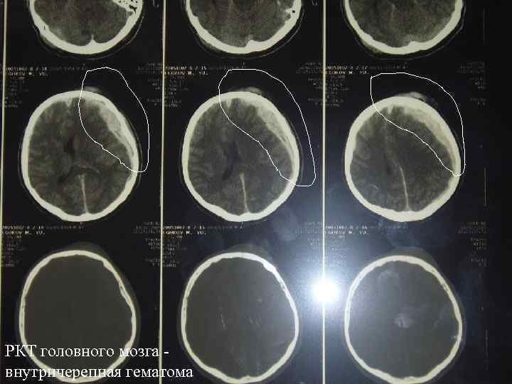 РКТ головного мозга внутричерепная гематома 