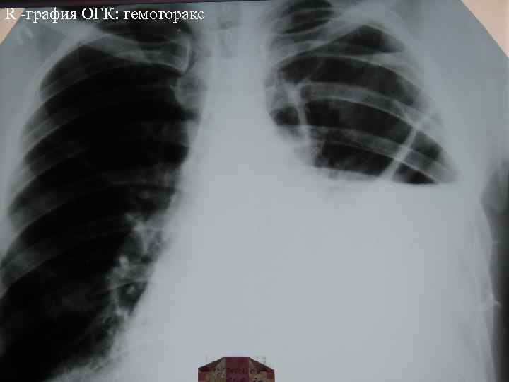 R -графия ОГК: гемоторакс 