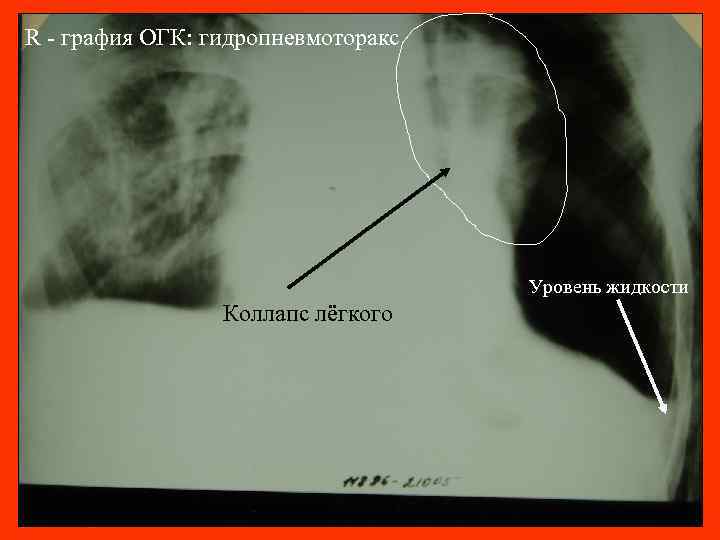 R - графия ОГК: гидропневмоторакс Уровень жидкости Коллапс лёгкого 