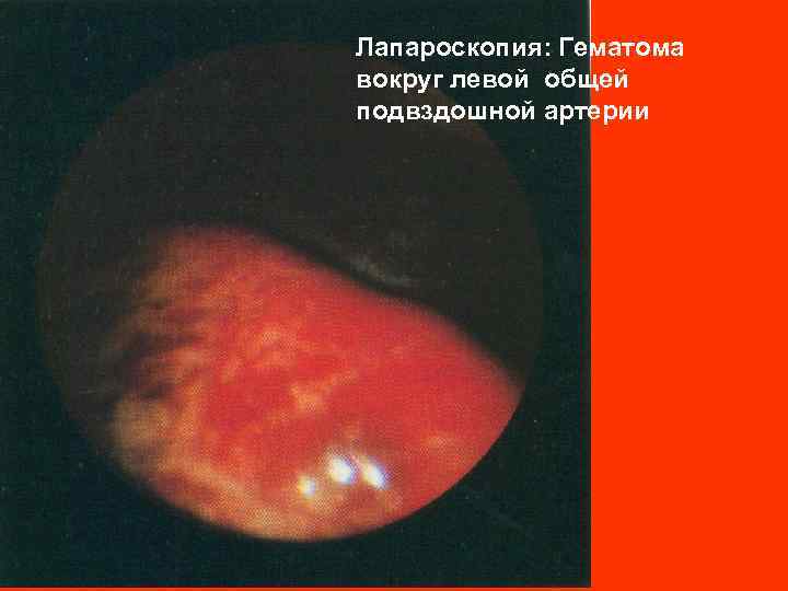 Лапароскопия: Гематома вокруг левой общей подвздошной артерии 