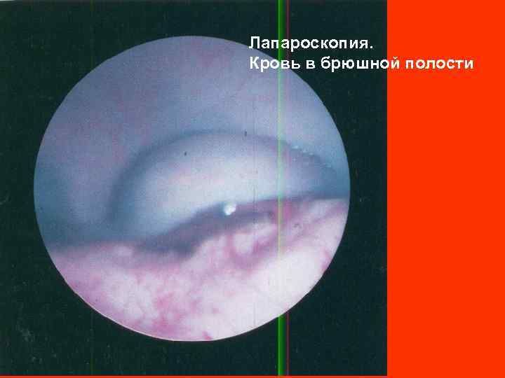 Лапароскопия. Кровь в брюшной полости 