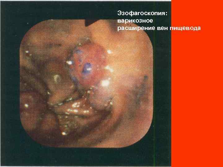 Эзофагоскопия: варикозное расширение вен пищевода 