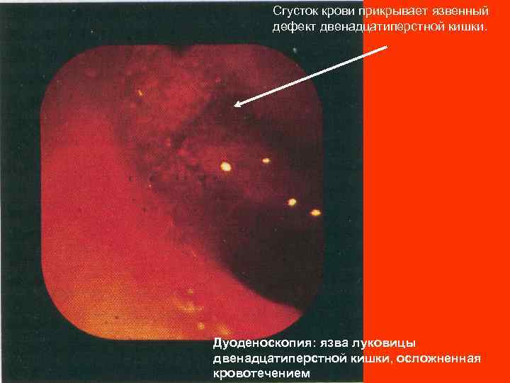 Сгусток крови прикрывает язвенный дефект двенадцатиперстной кишки. Дуоденоскопия: язва луковицы двенадцатиперстной кишки, осложненная кровотечением