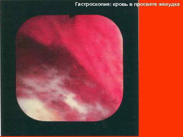 Гастроскопия: кровь в просвете желудка. 