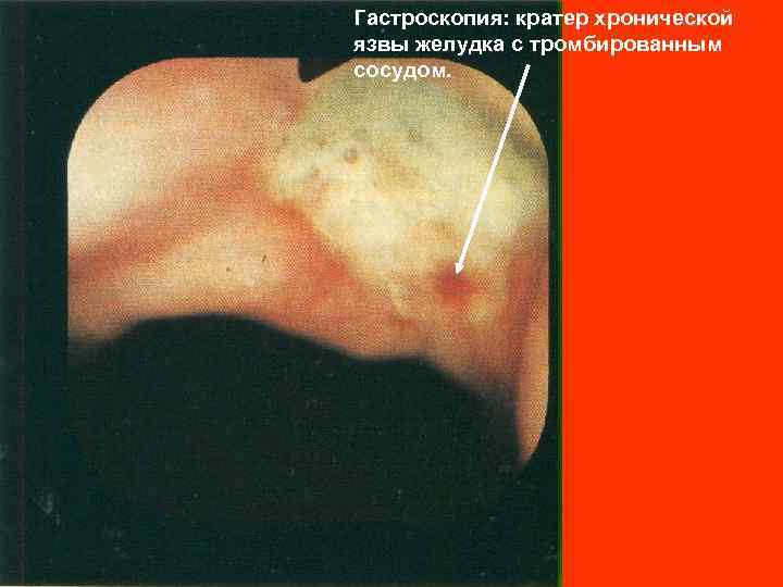 Гастроскопия: кратер хронической язвы желудка с тромбированным сосудом. 