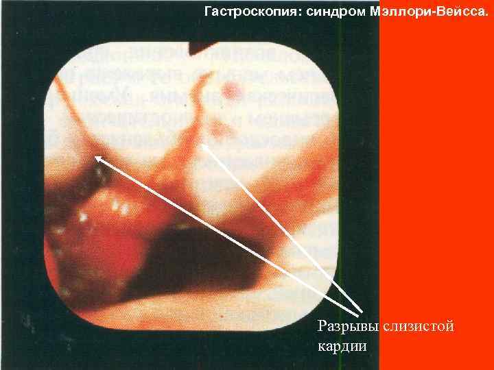 Гастроскопия: синдром Мэллори-Вейсса. Разрывы слизистой кардии 