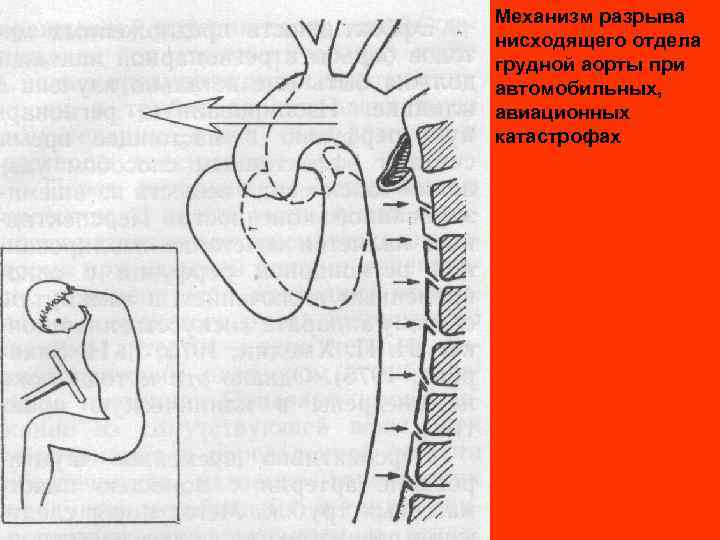 Механизм разрыва нисходящего отдела грудной аорты при автомобильных, авиационных катастрофах 