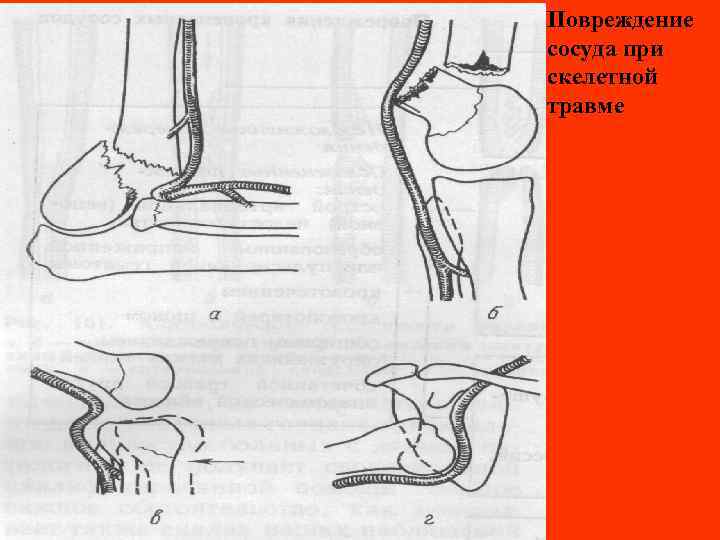 Повреждение сосуда при скелетной травме 