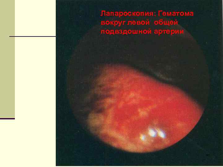 Лапароскопия: Гематома вокруг левой общей подвздошной артерии 41 