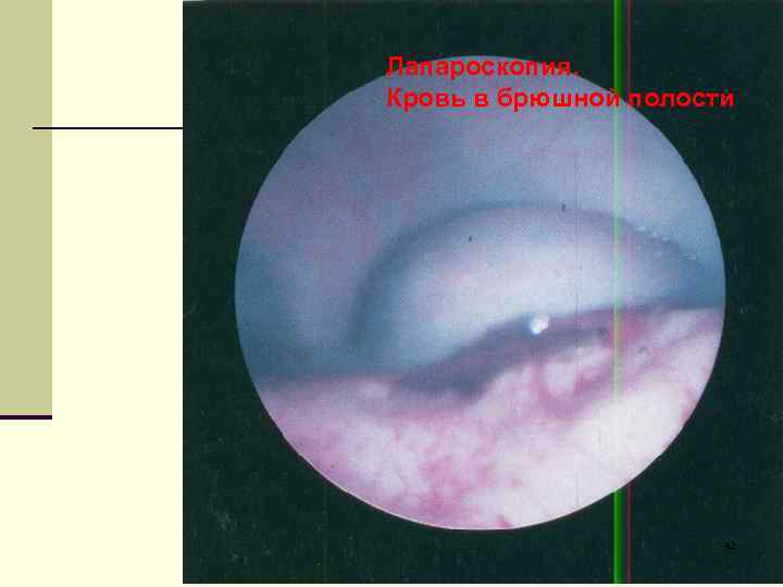 Лапароскопия. Кровь в брюшной полости 42 