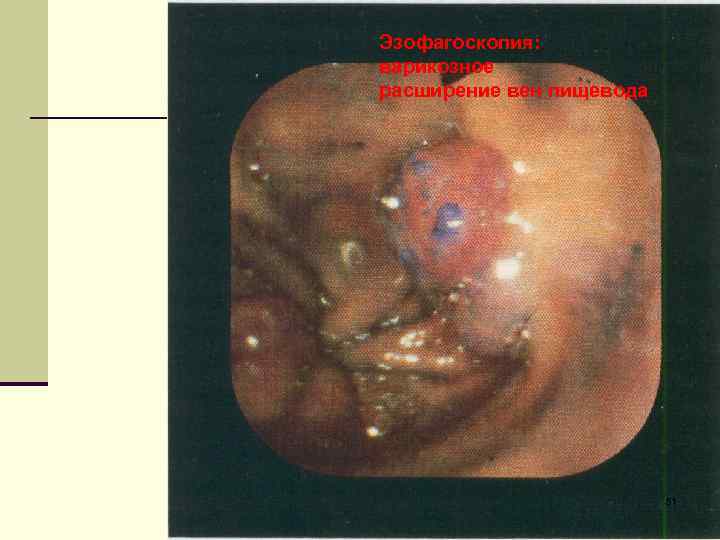 Эзофагоскопия: варикозное расширение вен пищевода 51 