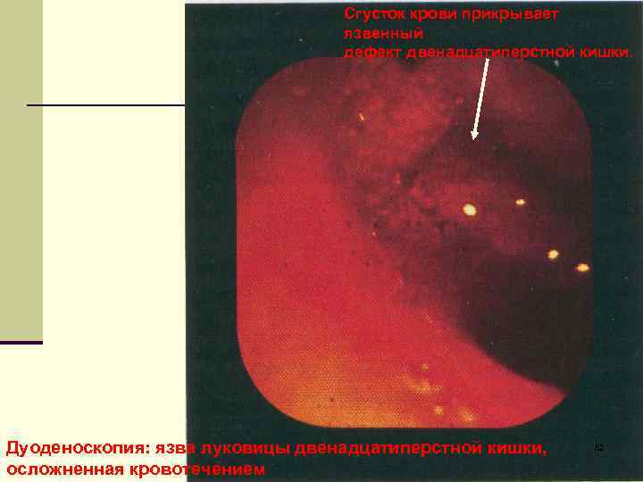 Сгусток крови прикрывает язвенный дефект двенадцатиперстной кишки. Дуоденоскопия: язва луковицы двенадцатиперстной кишки, осложненная кровотечением