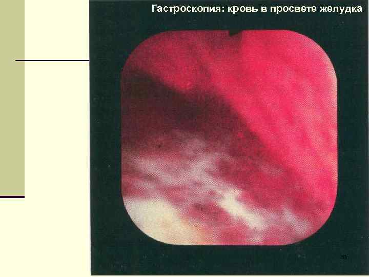 Гастроскопия: кровь в просвете желудка. 53 