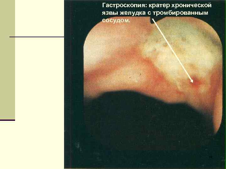 Гастроскопия: кратер хронической язвы желудка с тромбированным сосудом. 54 