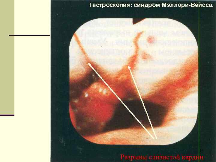 Гастроскопия: синдром Мэллори-Вейсса. 55 Разрывы слизистой кардии 