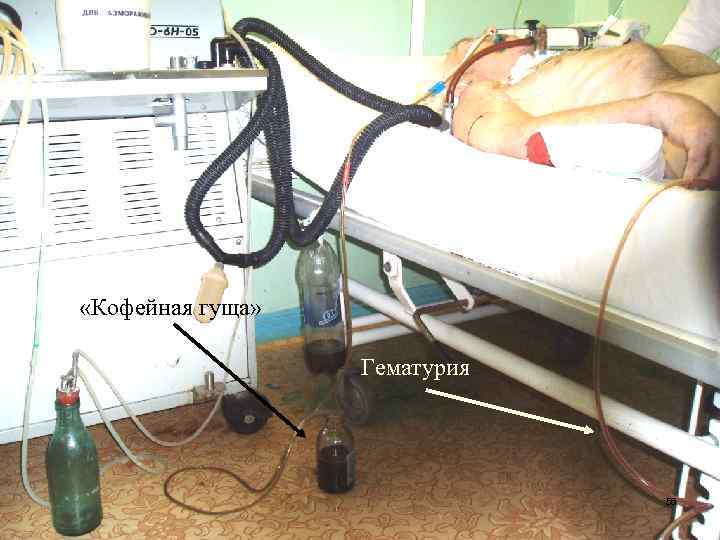  «Кофейная гуща» Гематурия 56 