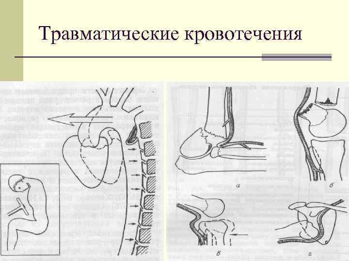 Травматические кровотечения 6 