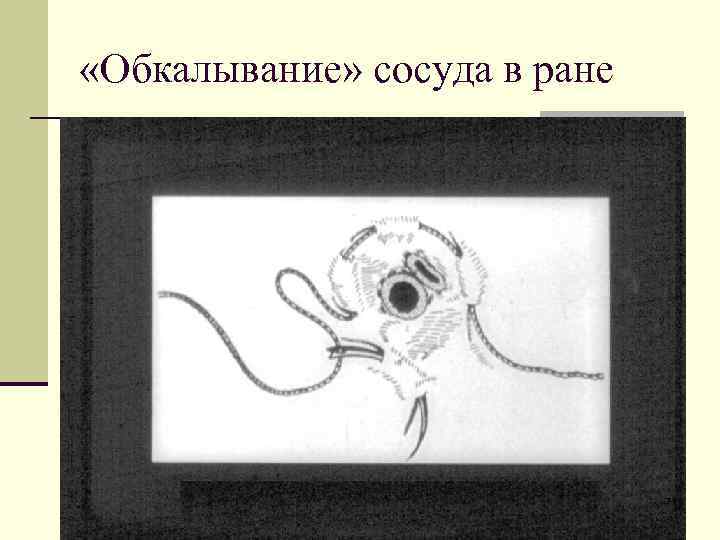  «Обкалывание» сосуда в ране 71 