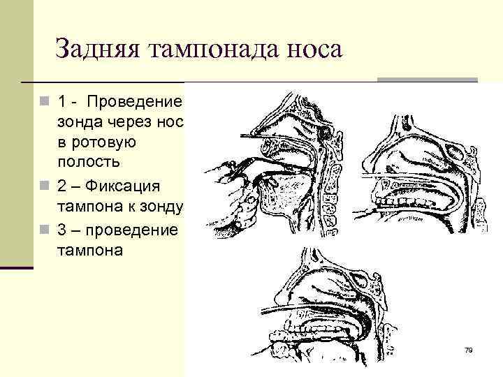 Задняя тампонада носа n 1 - Проведение зонда через нос в ротовую полость n