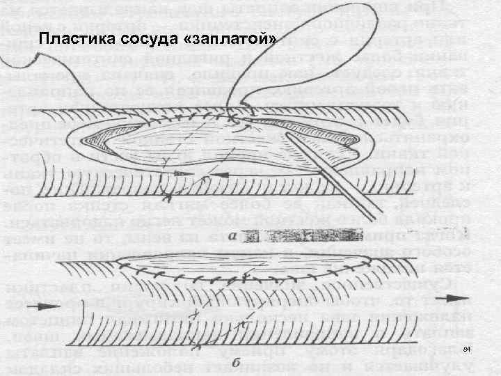 Пластика сосуда «заплатой» 84 