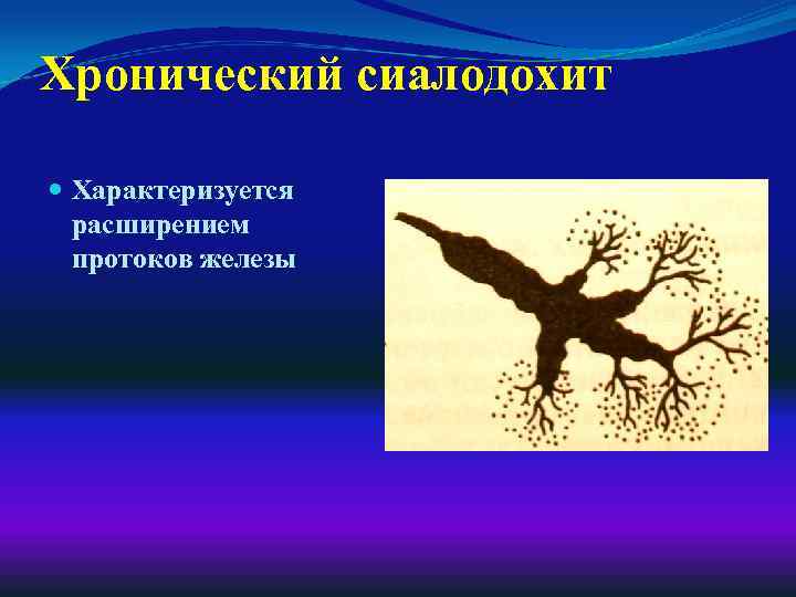 Хронический сиалодохит Характеризуется расширением протоков железы 