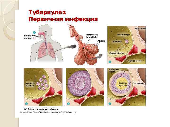 Туберкулез Первичная инфекция 