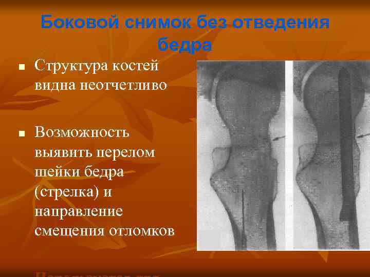 Боковой снимок без отведения бедра n n Структура костей видна неотчетливо Возможность выявить перелом