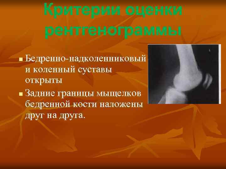Критерии оценки рентгенограммы Бедренно-надколенниковый и коленный суставы открыты n Задние границы мыщелков бедренной кости