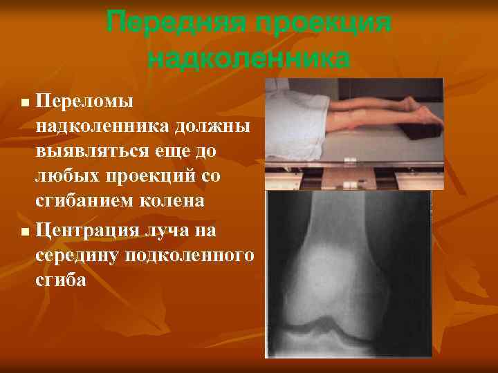 Передняя проекция надколенника Переломы надколенника должны выявляться еще до любых проекций со сгибанием колена