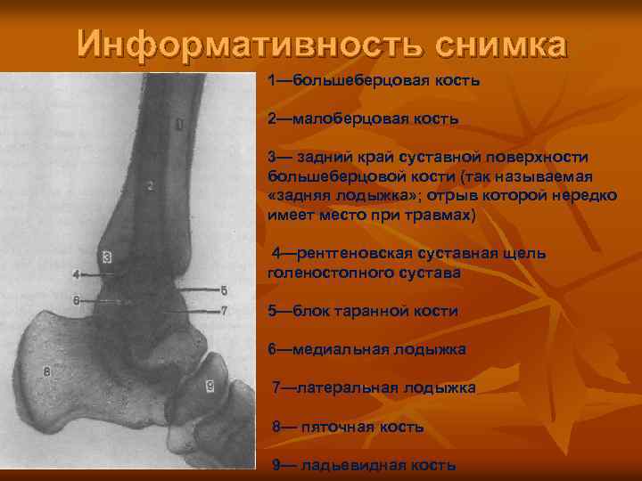 Информативность снимка 1—большеберцовая кость 2—малоберцовая кость 3— задний край суставной поверхности большеберцовой кости (так