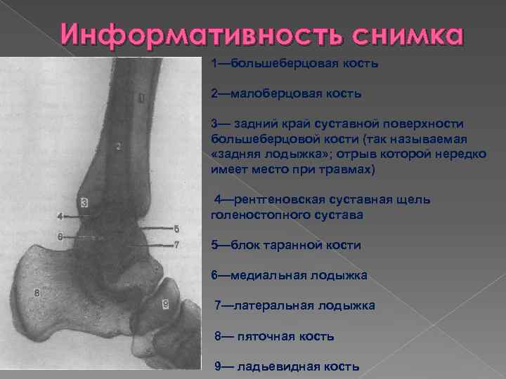 Большеберцовая кость где находится у человека фото на ноге