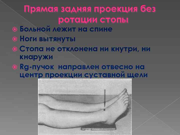 Прямая задняя проекция без ротации стопы Больной лежит на спине Ноги вытянуты Стопа не